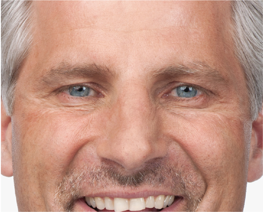 Botox treatment, after