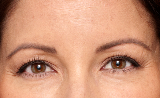 Botox treatment, after