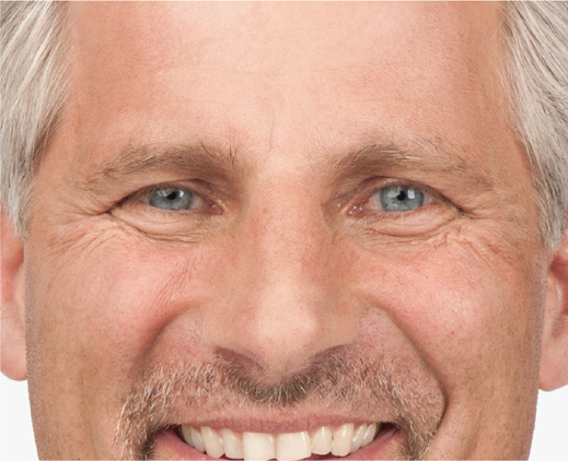 Botox treatment, before