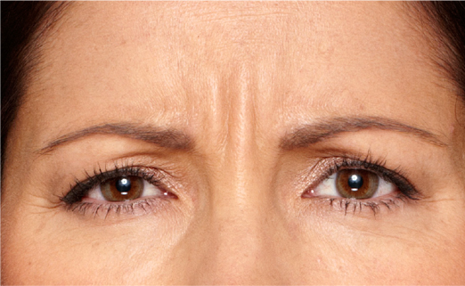 Botox treatment, before