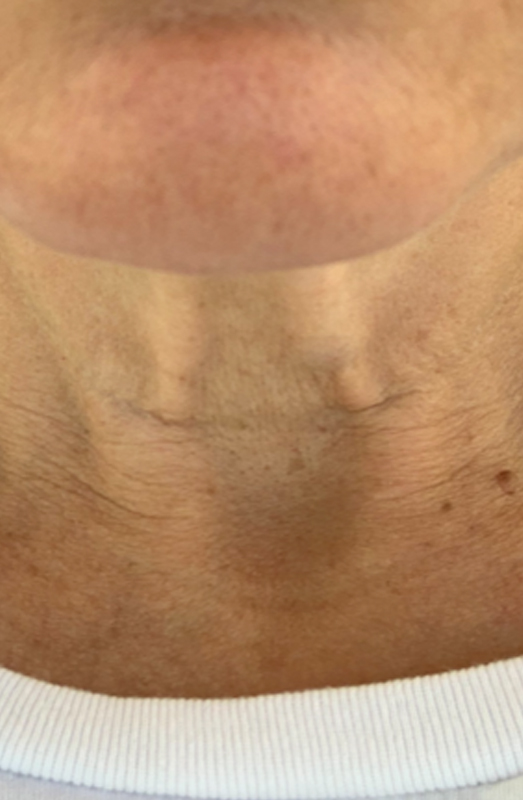 Neck & décolletage, before