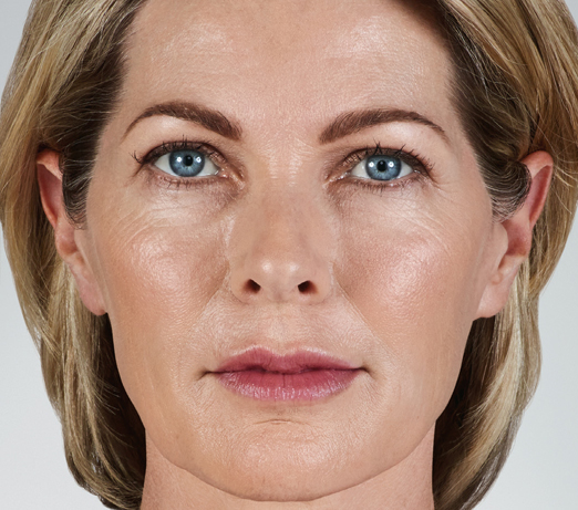 Dermal filler, after