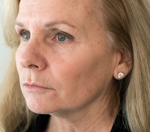 Dermal filler, after