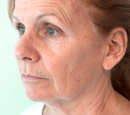 Dermal filler, before