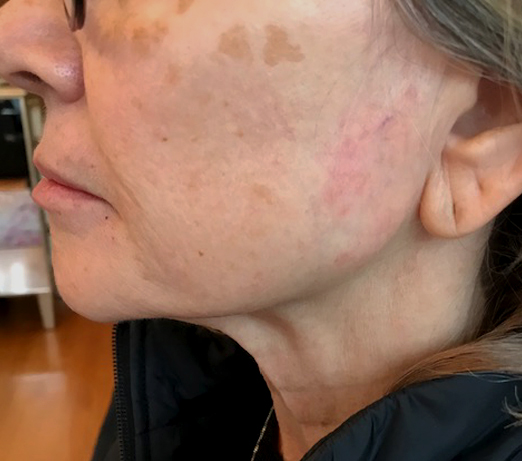 Dermal filler, after