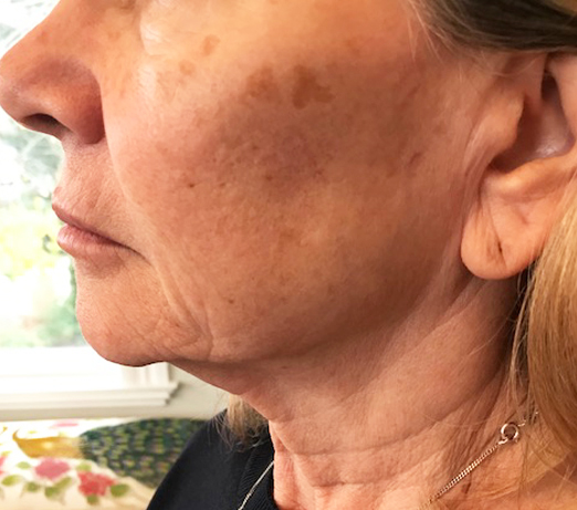 Dermal filler, before