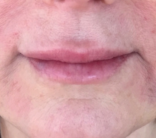 Lip filler, after