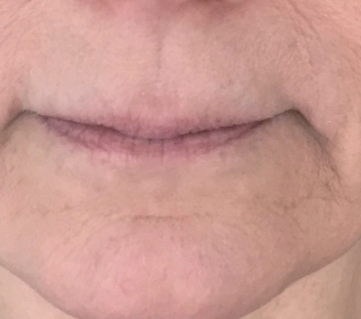 Lip filler, before