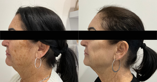 IPL photofacial before-and-after results