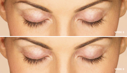 Latisse lash treatment, before