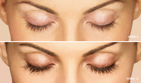 Latisse lash growth result