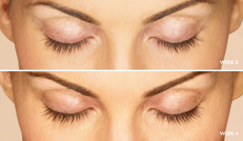 Latisse lash growth result