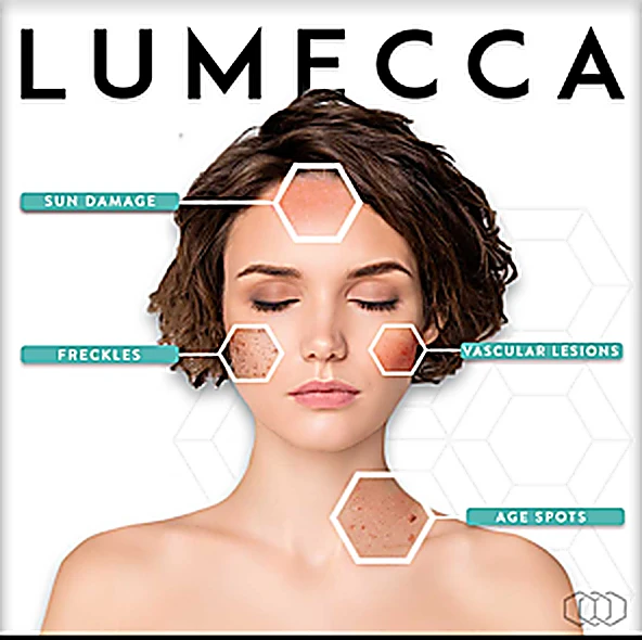 Lumecca IPL treats sun damage, freckles, vascular lesions, and age spots — manufacturer education diagram
