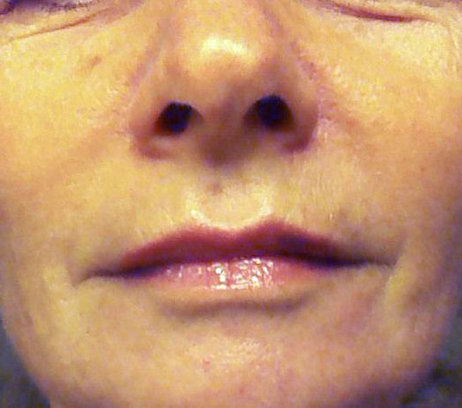 Restylane filler, after