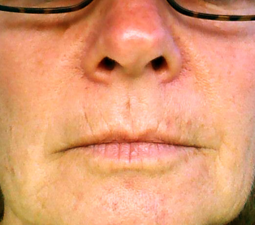 Restylane filler, before