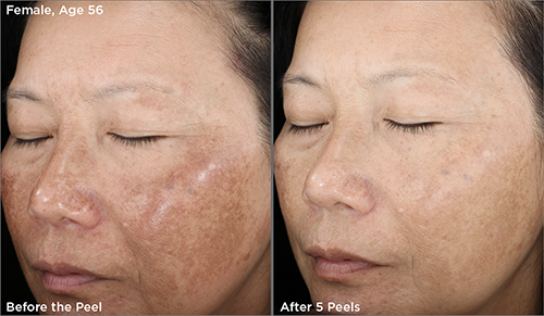 SkinMedica peel, before and after