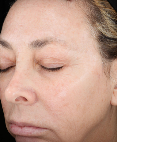 Vitalize peel, after