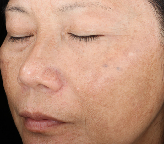 Vitalize peel, after