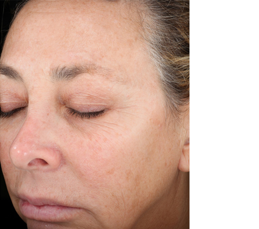Vitalize peel, before