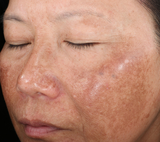 Vitalize peel, before